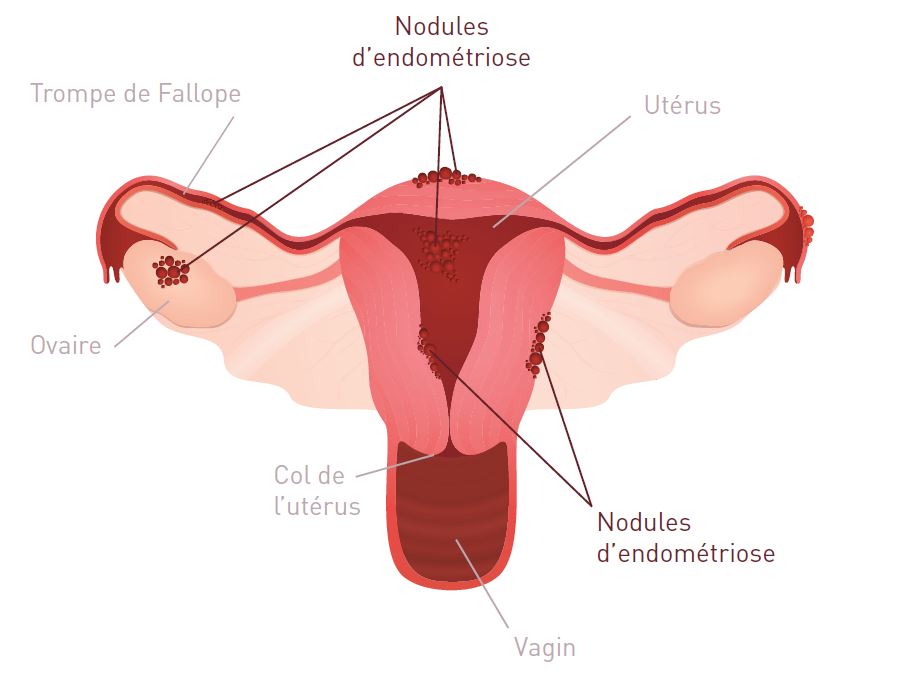 endometriose-shema