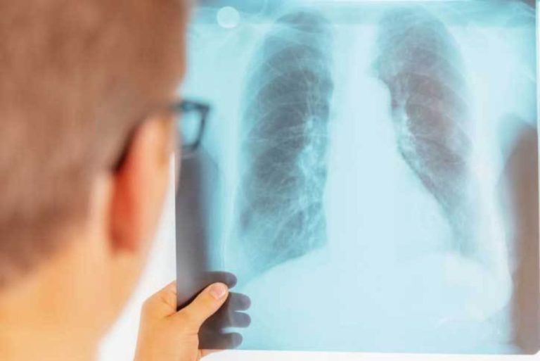 La pneumonie, quels sont les symptômes et comment en guérir