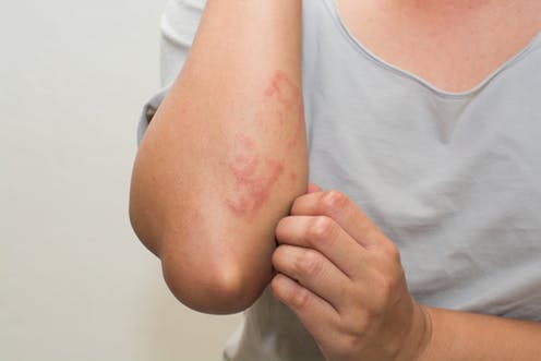 eczema